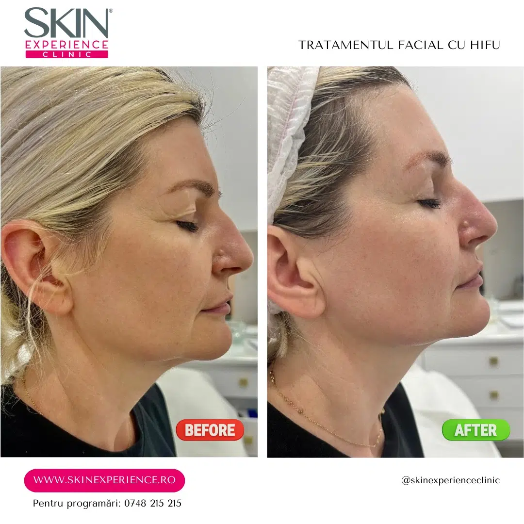 Lifting facial total cu HIFU – Microson™ Pen - imagine 18