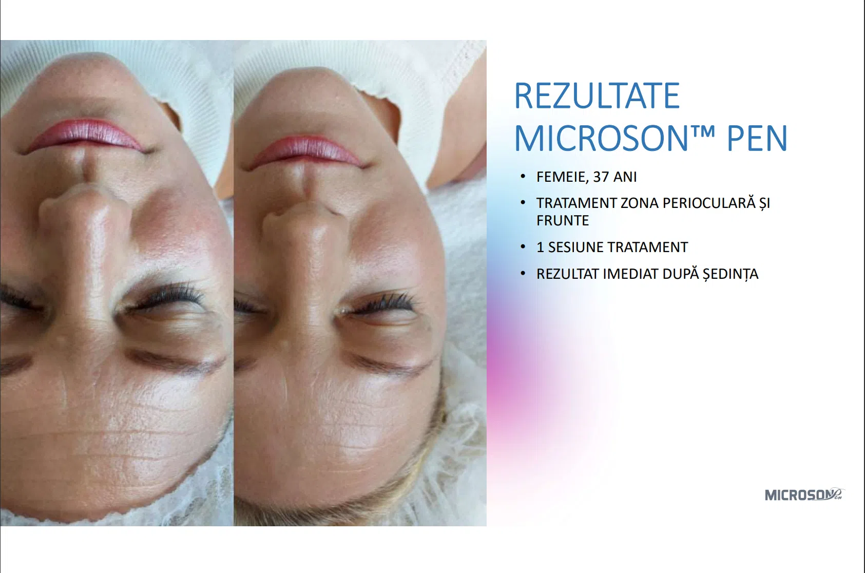 Lifting facial total cu HIFU – Microson™ Pen - imagine 10