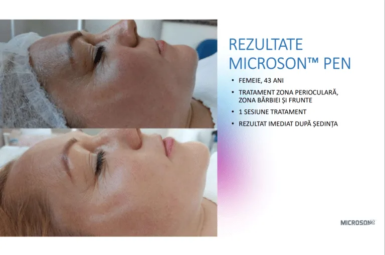Lifting facial total cu HIFU – Microson™ Pen - imagine 11