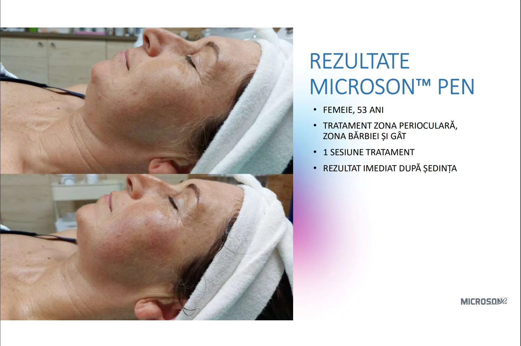 Lifting facial total cu HIFU – Microson™ Pen - imagine 12