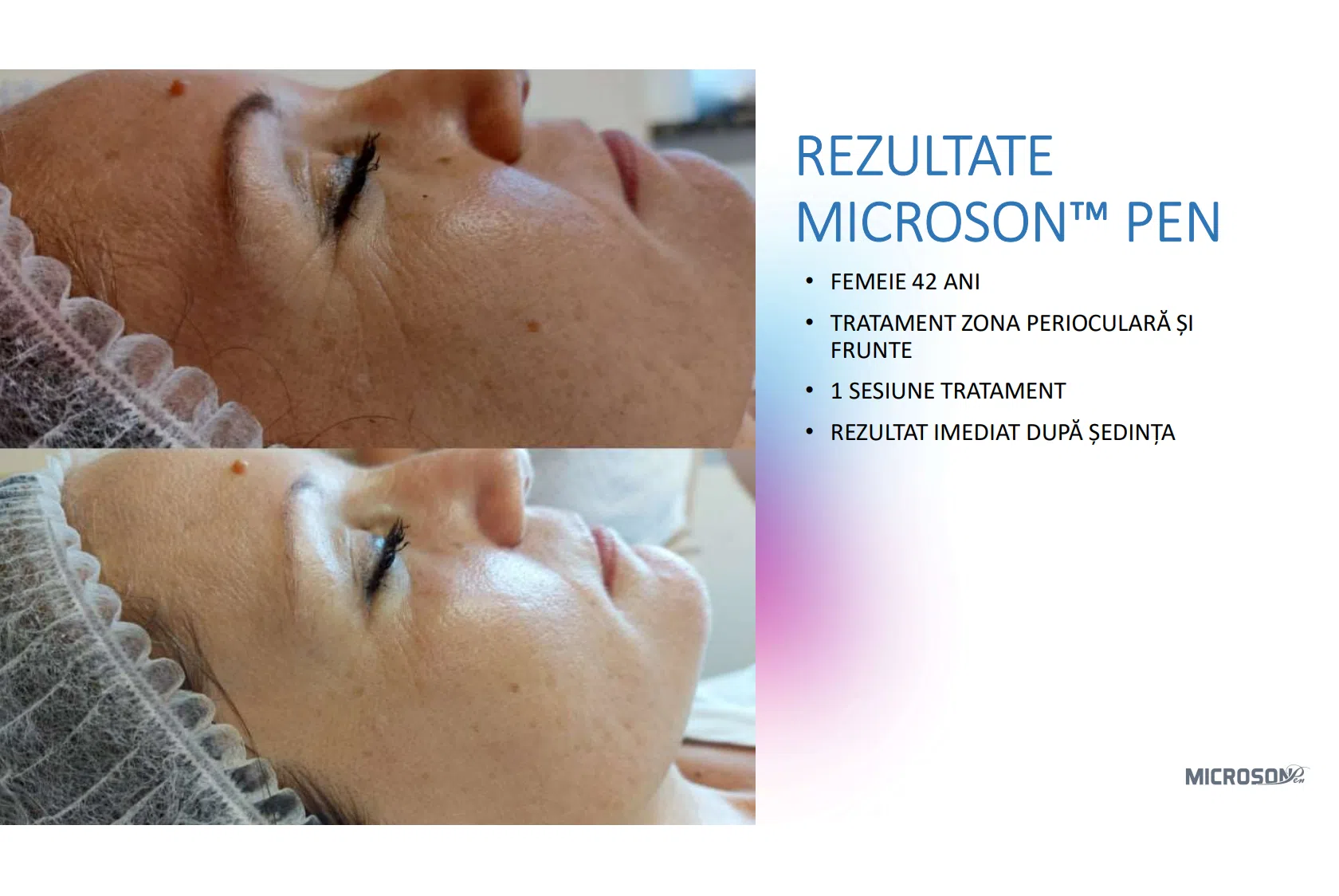 Lifting facial total cu HIFU – Microson™ Pen - imagine 13
