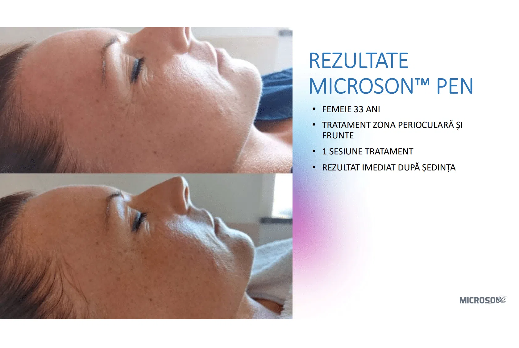 Lifting facial total cu HIFU – Microson™ Pen - imagine 14