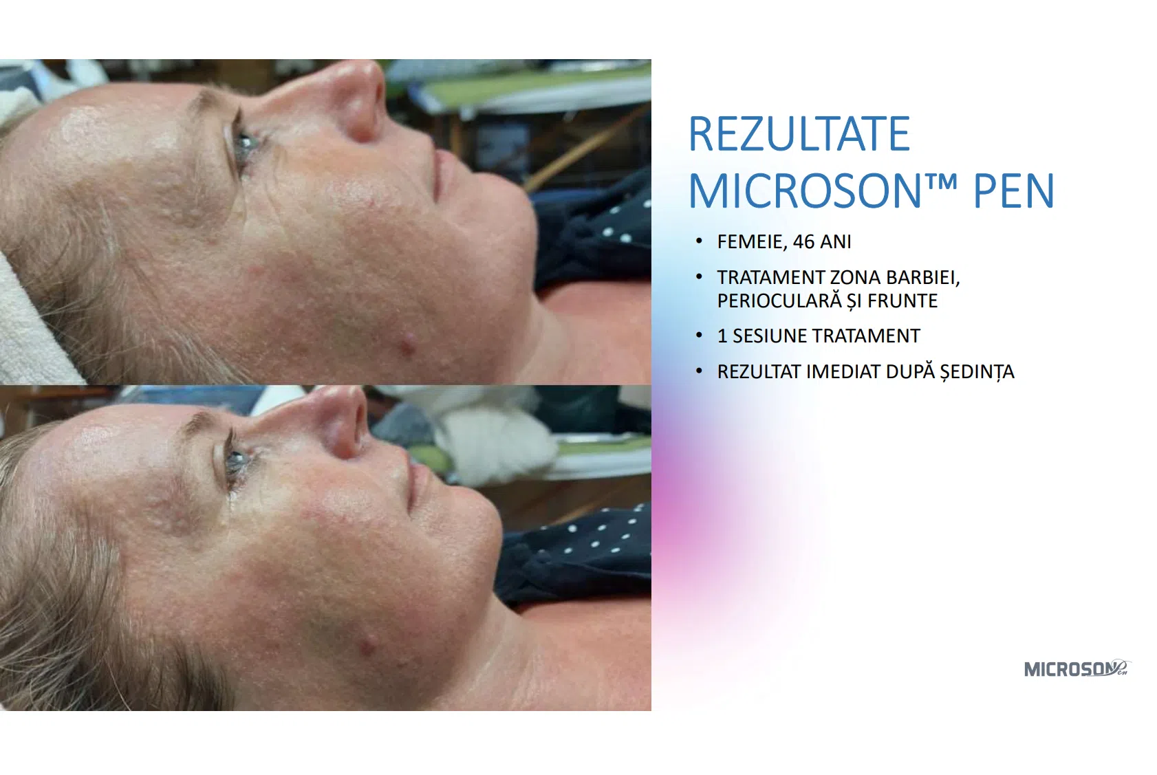 Lifting facial total cu HIFU – Microson™ Pen - imagine 15