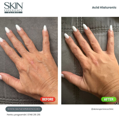 Injectare acid hialuronic - imagine 2
