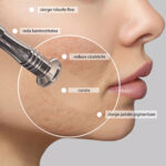 Microdermabraziune facială cu pulbere de diamant