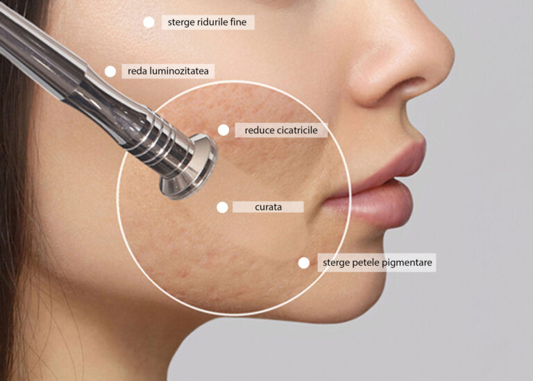 microdermabraziune