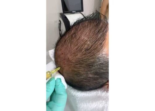 Terapia Vampir (PRP) – Rejuvenare naturală pentru piele și stimularea creșterii părului - imagine 4