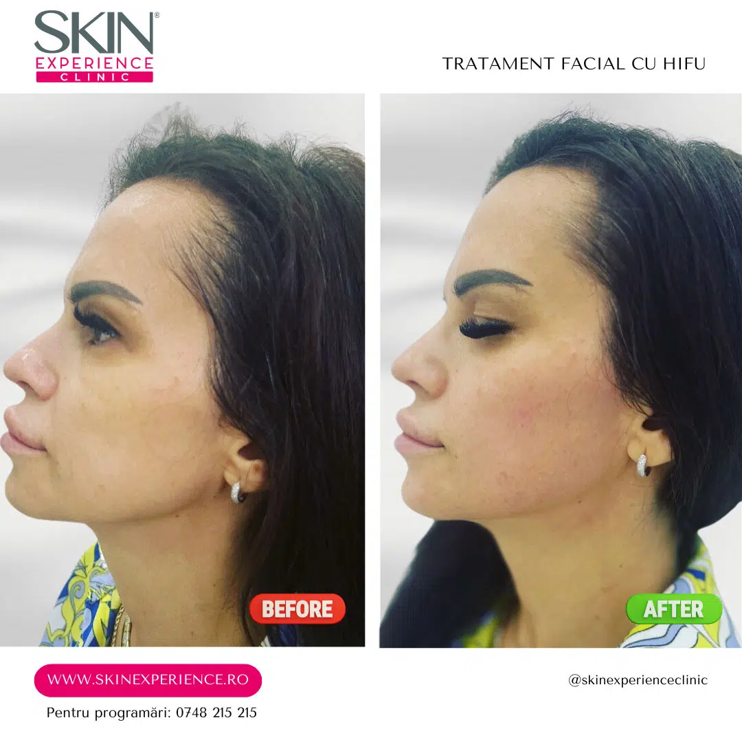Lifting facial total cu HIFU – Microson™ Pen - imagine 16