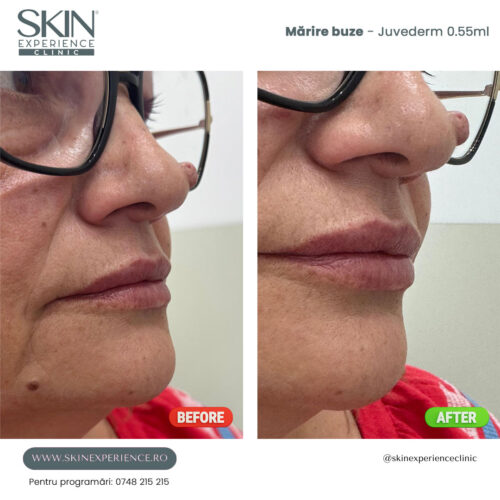 Mărire buze cu acid hialuronic - imagine 4