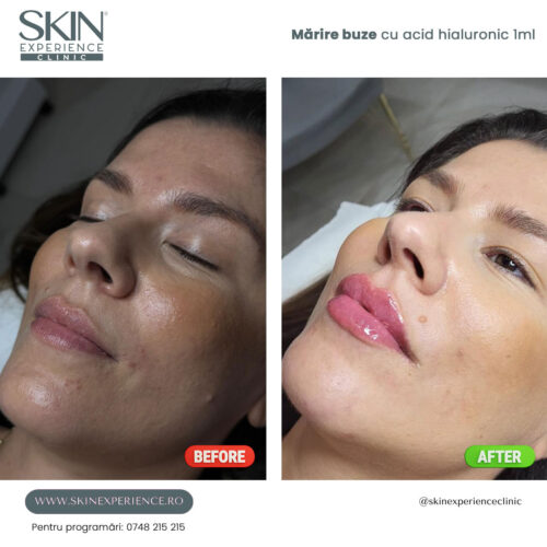 Mărire buze cu acid hialuronic - imagine 2