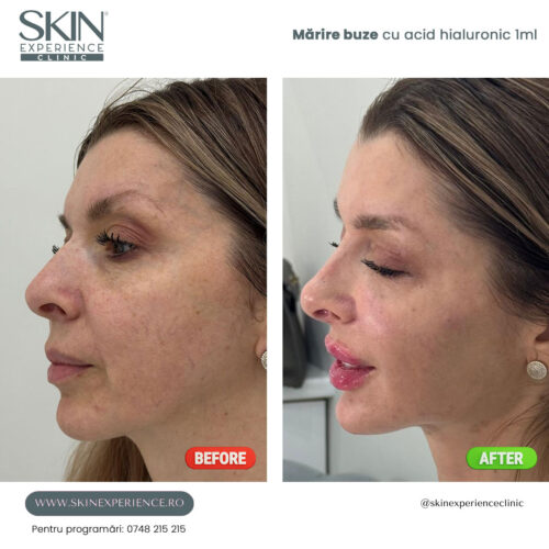 Mărire buze cu acid hialuronic - imagine 3