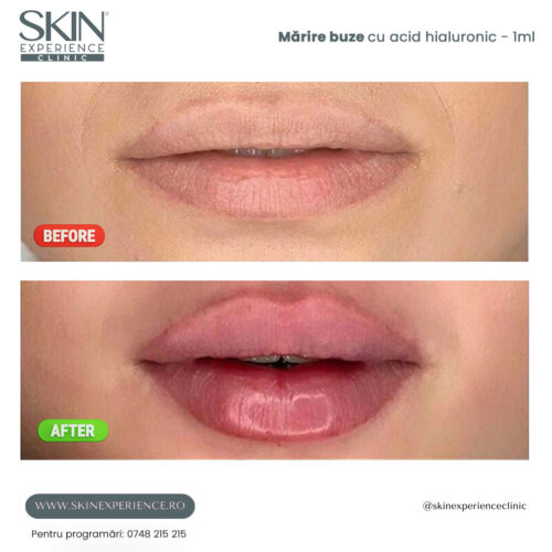 Mărire buze cu acid hialuronic - imagine 5