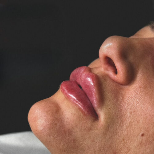 Mărire buze cu acid hialuronic - imagine 8