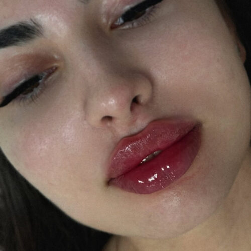 Mărire buze cu acid hialuronic - imagine 7