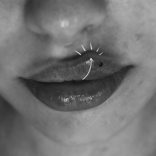 Mărire buze cu acid hialuronic - imagine 6