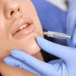 Mărire buze cu acid hialuronic