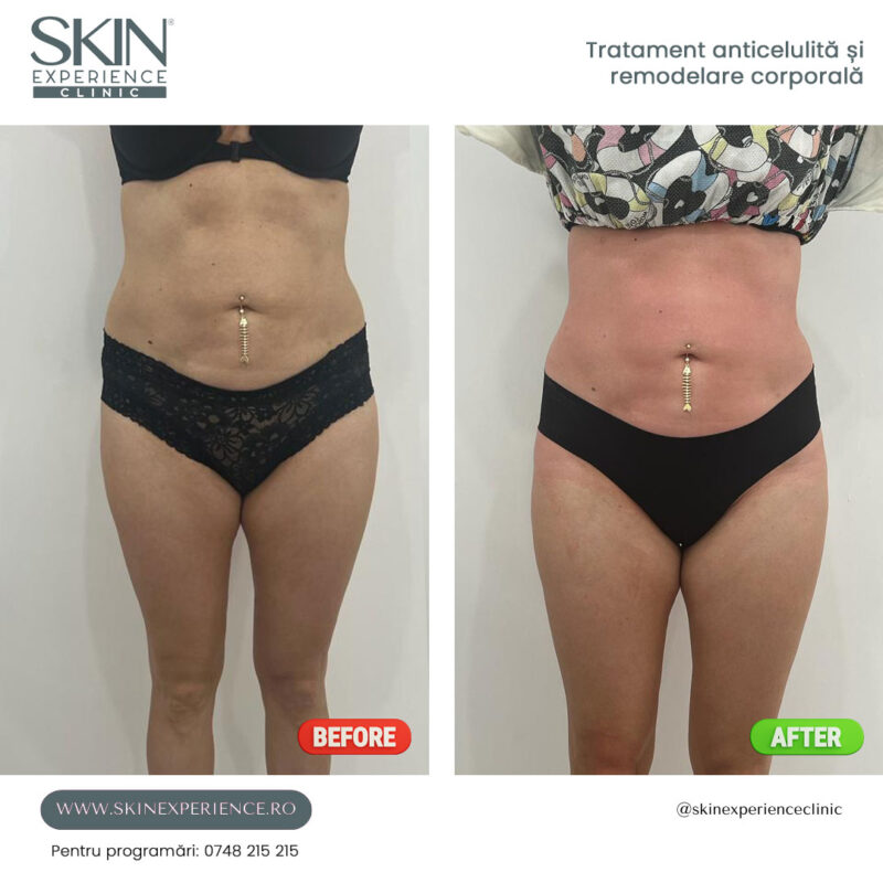 powershape aniticelulita remodelare 2