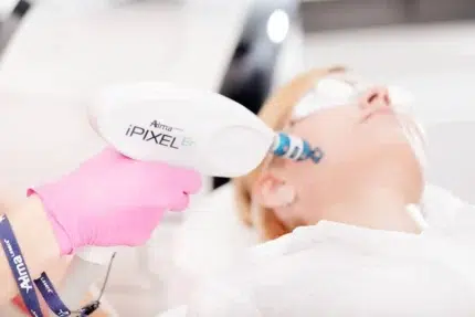 tratament laser co2