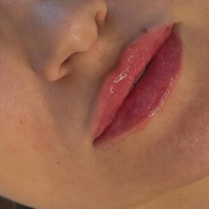 dr-hamed-rawnak-injectari (3)