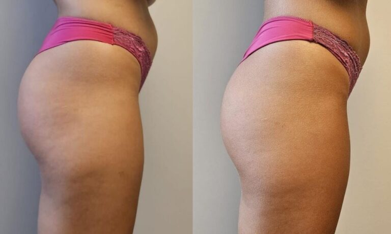 volumizare-fese-lanluma-x-profil-1