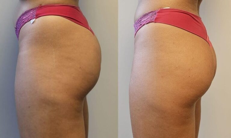 volumizare-fese-lanluma-x-profil-2